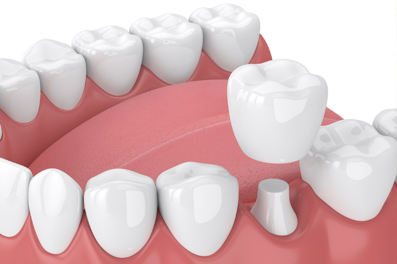 Dental Crowns in Stamford