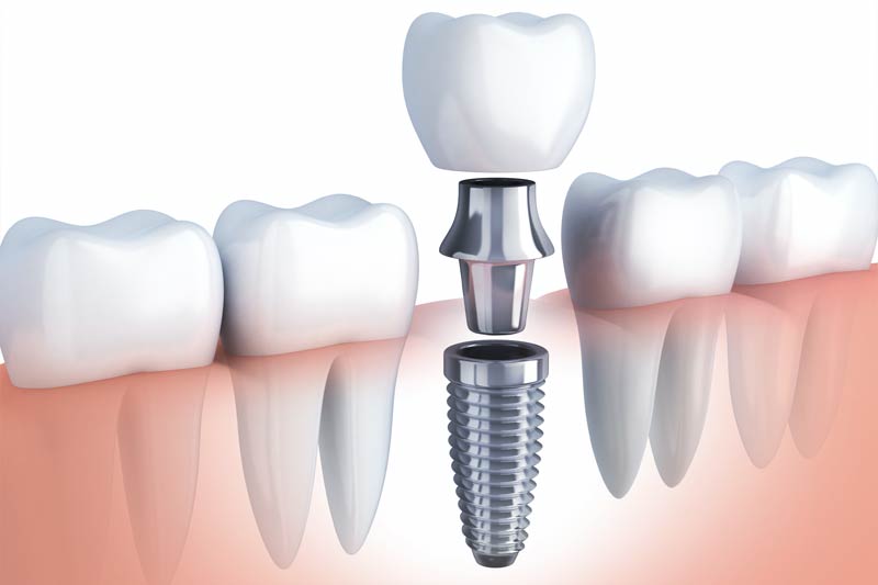 Dental Implants in Stamford