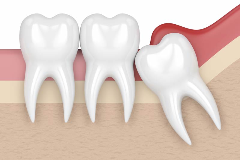 Wisdom Tooth Removal in Stamford